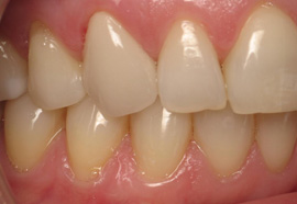 after tooth repair | The Dental Place | Grand Prairie TX