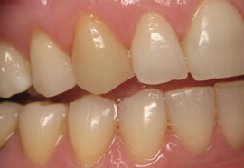 yellow teeth | The Dental Place | Grand Prairie TX
