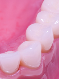 tooth colored fillings | The Dental Place | Grand Prairie TX