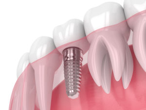 dental implants Arlington TX